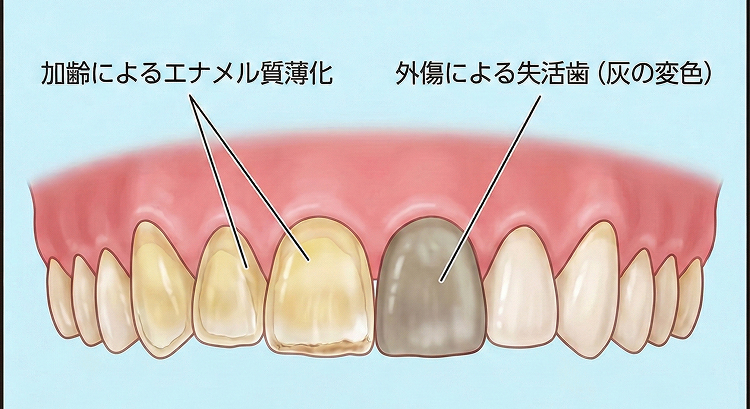 失活歯による変色