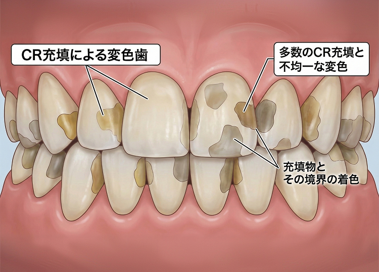 Case4ジルコブライト®エナメル質形成不全＋多数CR充填の審美障害(症状説明図)