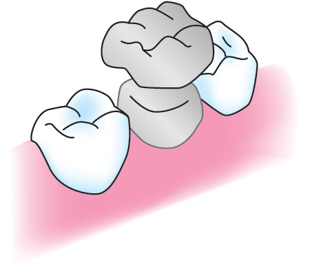 セラミック　歯