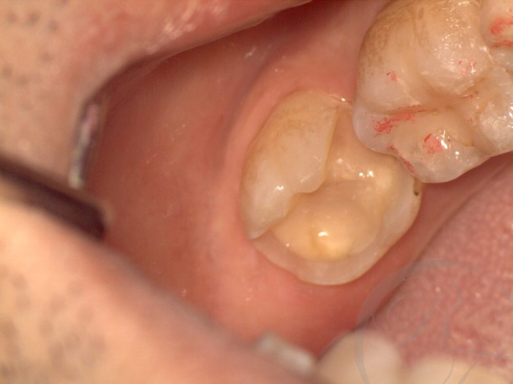 インプラント歯