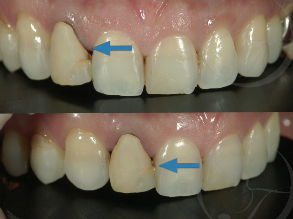 セラミック 歯 欠け た 修理