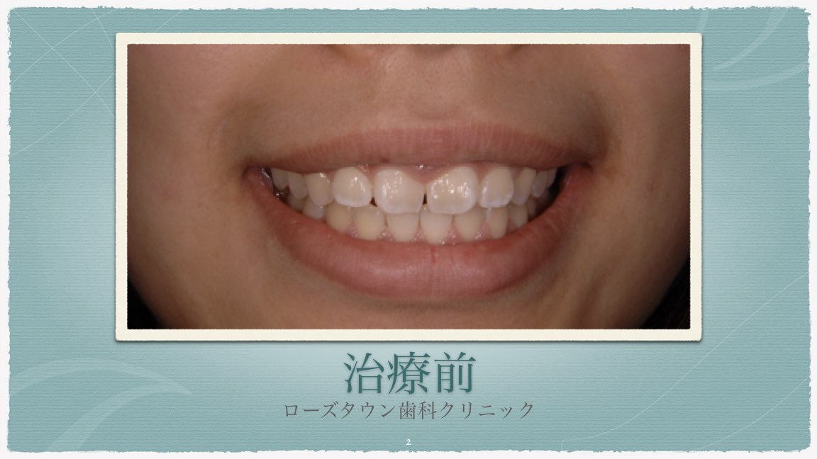 歯が小さい すきっ歯 ガミースマイルの改善 浦安市の歯医者 新浦安駅のローズタウン歯科クリニック