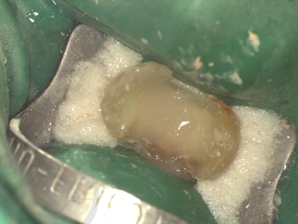 セラミック歯