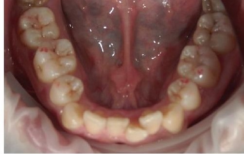 まえ歯のみの部分矯正治療例 浦安市の歯医者 新浦安駅のローズタウン歯科クリニック