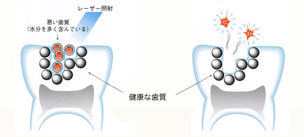 Er.YAG (エルビウムヤグ)レーザーによる低侵襲な虫歯治療