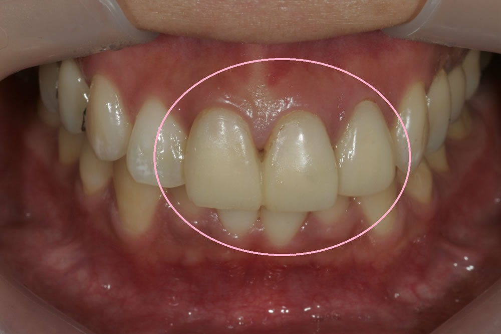 仮歯の精度