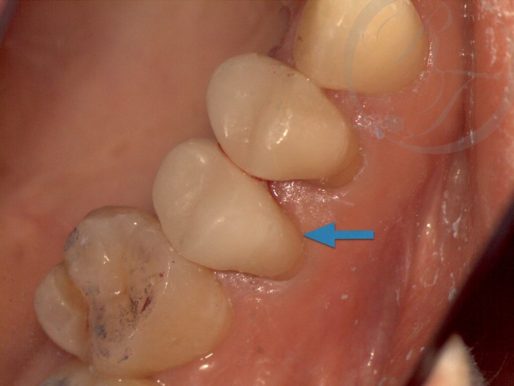 インプラント歯